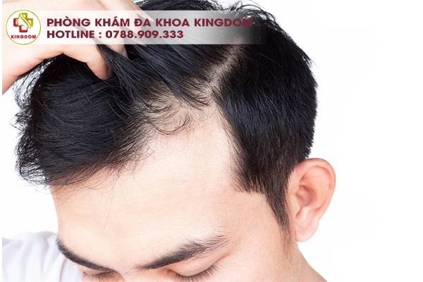 Các đối tượng phù hợp với phương pháp cấy tóc HAT