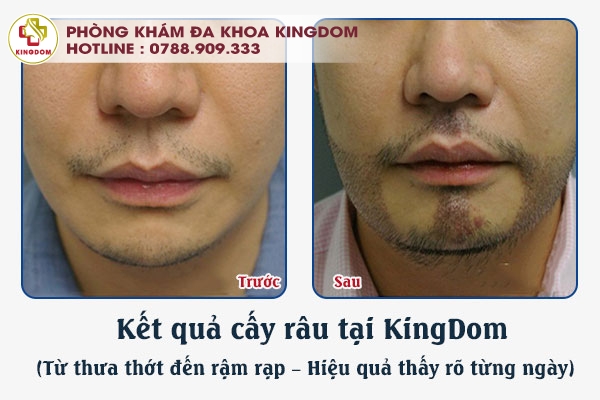 kết quả cấy râu KingDom