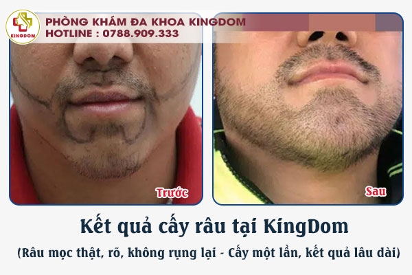 kết quả cấy râu KingDom