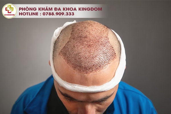Dịch vụ cấy tóc FUE tại phòng khám cấy tóc Nam Bộ - Kingdom
