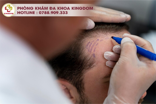 Cấy tóc HAT - Phương pháp đang được lưa chọn nhiều bởi các khách hàng thực hiện cấy tóc tại Kingdom
