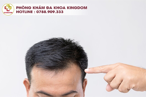 Những khách hàng bị hói tóc trán, đỉnh đầu hoặc tóc thưa mỏng rất phù hợp để sử dụng phương pháp FUE