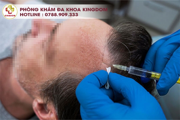 Quy trình cấy tóc tại Nam Bộ - Kingdom chuẩn quốc tế, chuyên nghiệp, mang lại sự hài lòng cho khách hàng