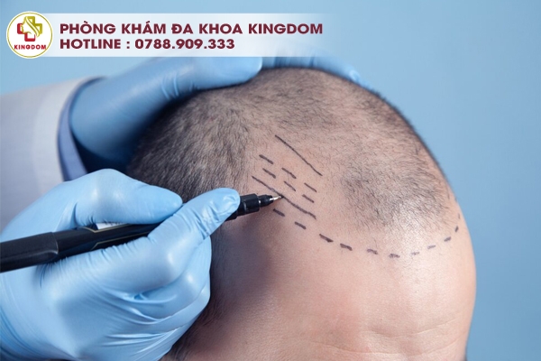 Quy trình cấy tóc chuyên nghiệp, chuẩn quốc tế khi cấy tóc tại Kingdom